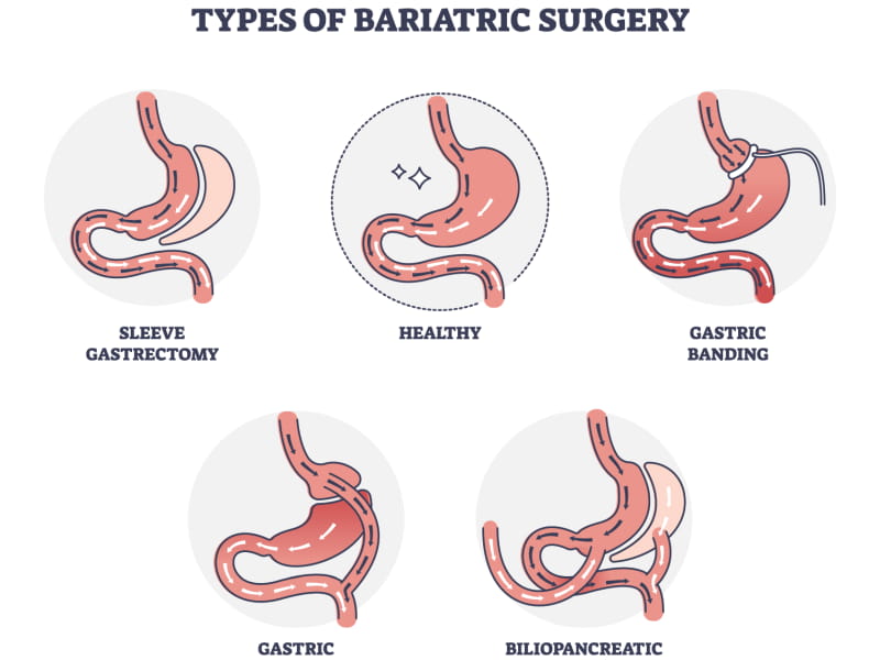 Bariatric Surgery Cost