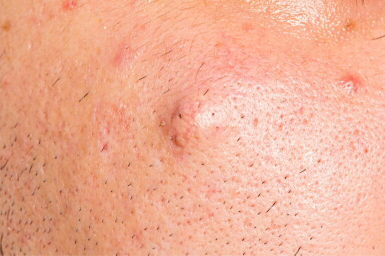 Sebaceous Cyst