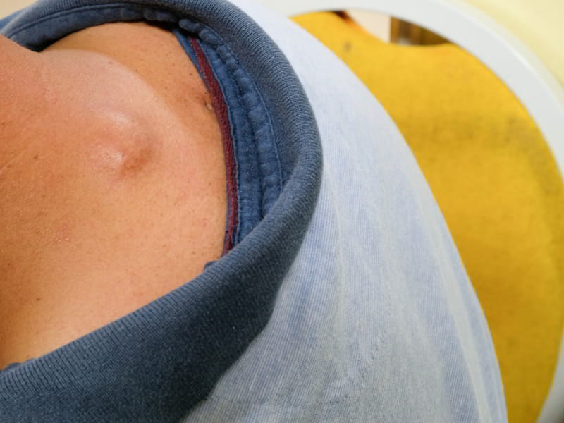 Sebaceous Cyst Removal