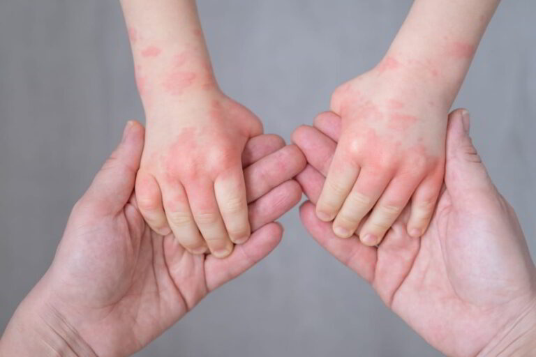 Eczema Treatment