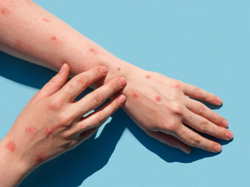 Treatment Of Monkeypox