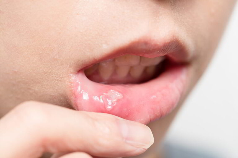 Mouth Ulcer Treatment