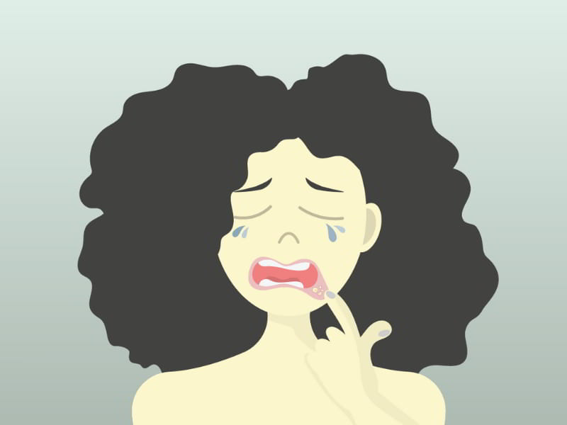 Best Mouth Ulcer Treatment