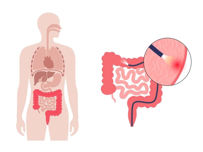Colonoscopy Cost