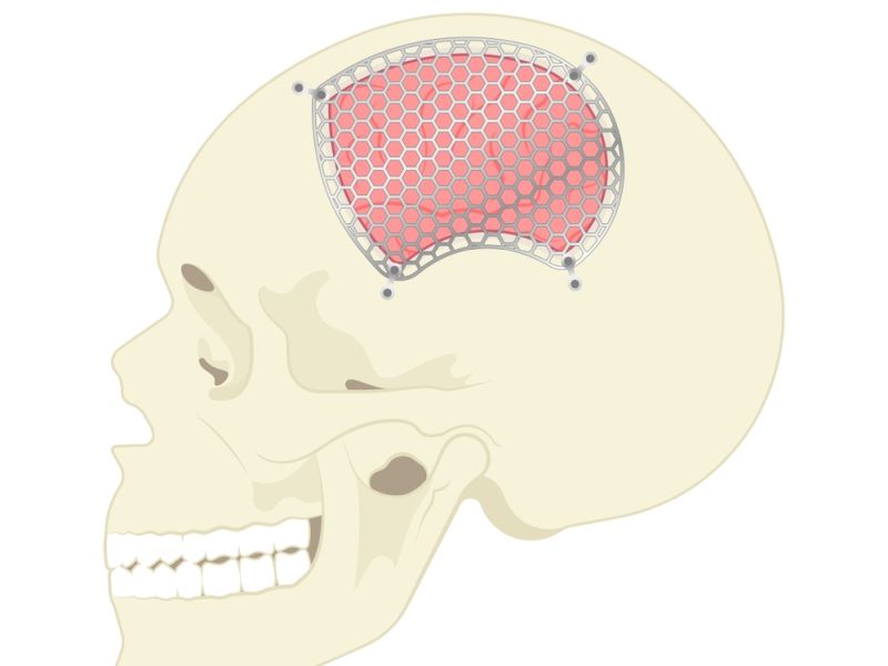 Cranioplasty Surgery
