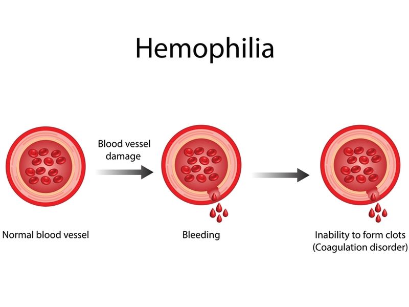 Haemophilia Symptoms
