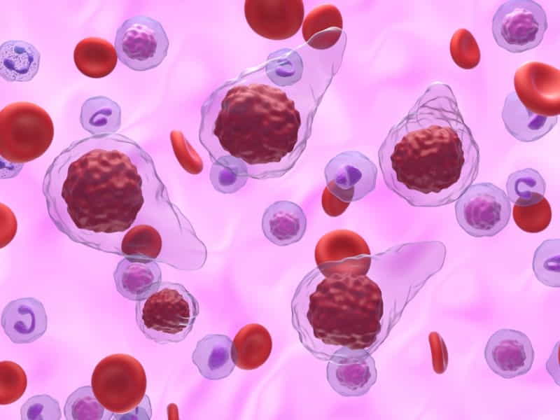Primary Myelofibrosis