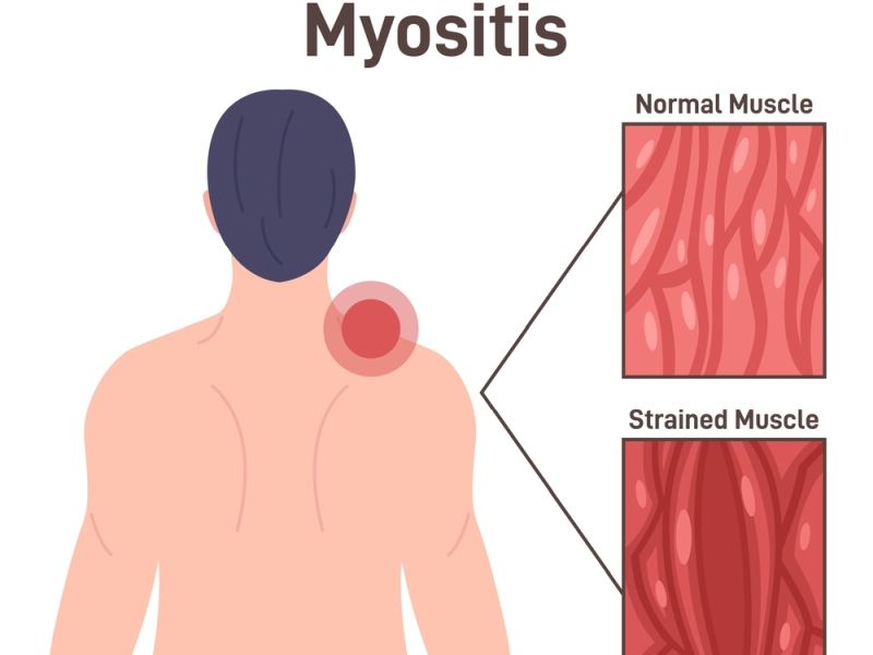 Treatment For Myositis