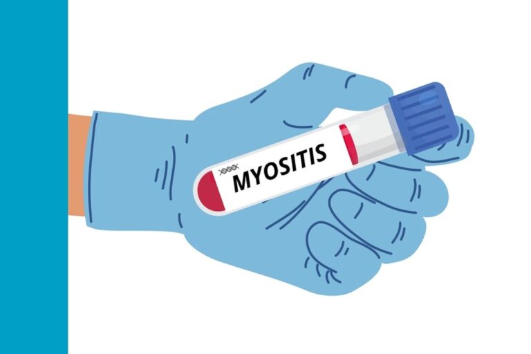 Myositis Treatment