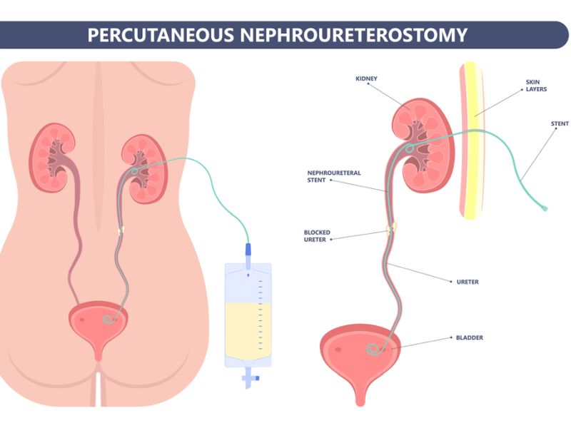 Percutaneous Nephrolithotomy Procedure