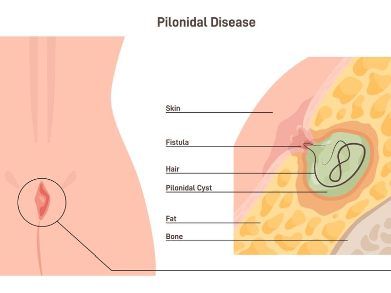 Pilonidal Sinus Surgery Cost
