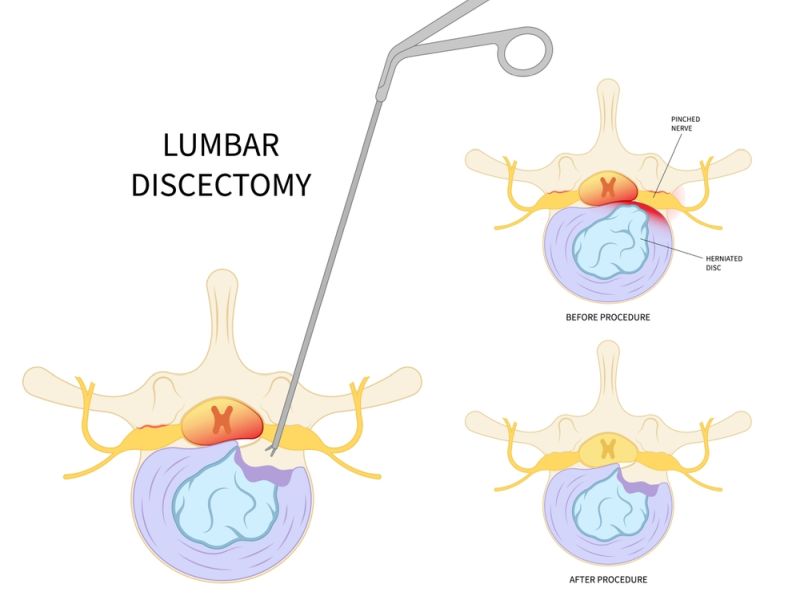 Discectomy Meaning