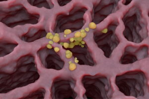 Salivary Gland Cancer