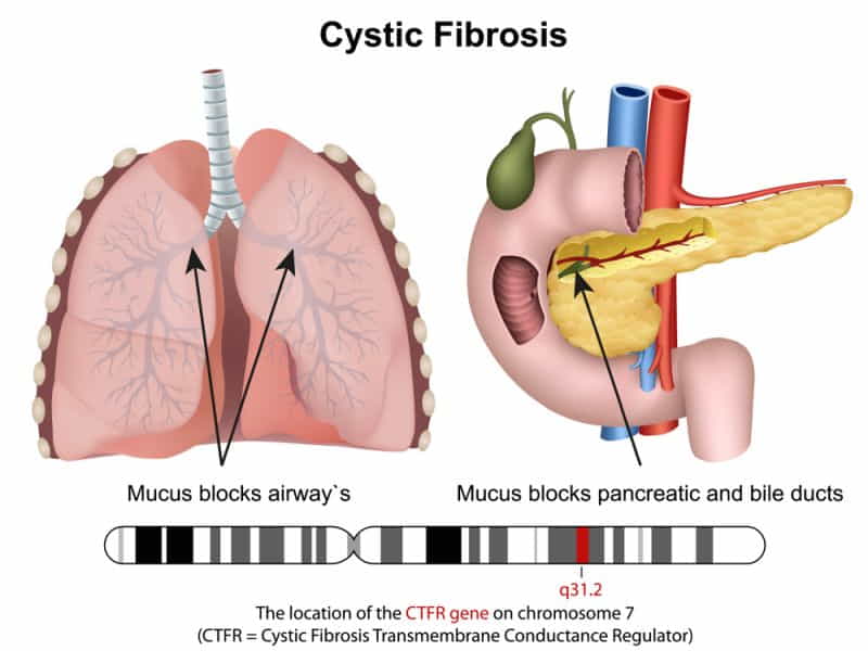 Cystic Fibrosis Symptoms