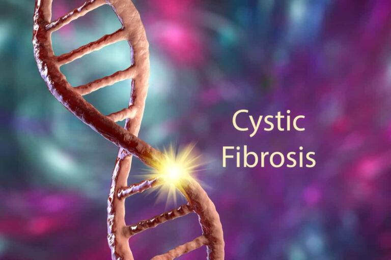 Cystic Fibrosi
