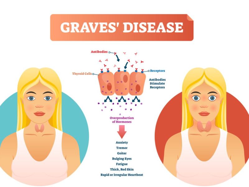 Graves' Disease Symptoms