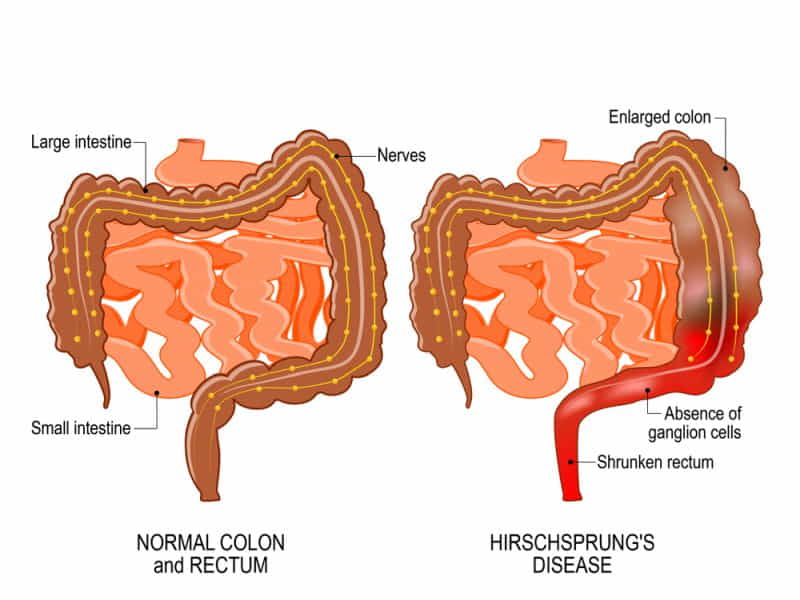 Hirschsprung Disease Symptoms