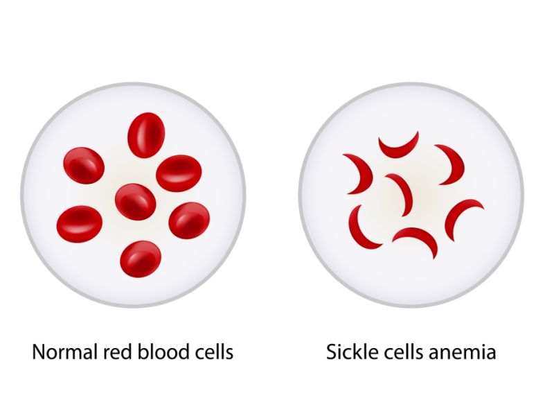Sickle Cell Anemia Symptoms