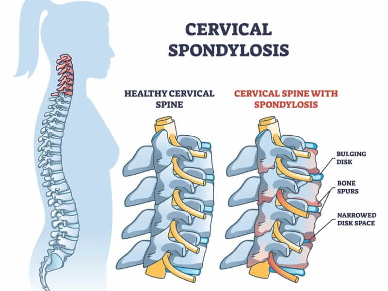 Cervical Spondylosis Symptoms