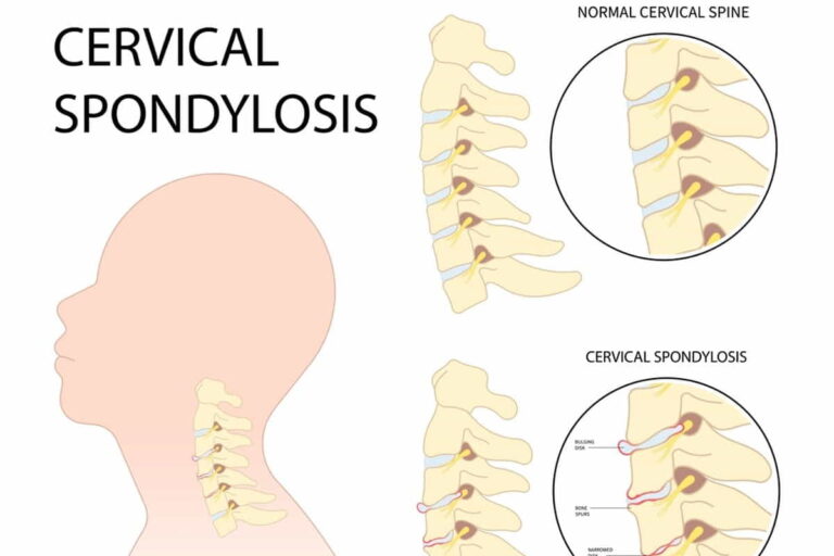 Cervical Spondylosis