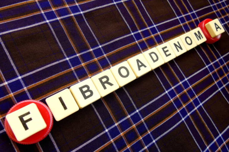 Fibroadenoma Symptoms