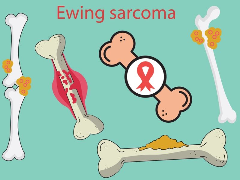 Ewing Sarcoma Symptoms