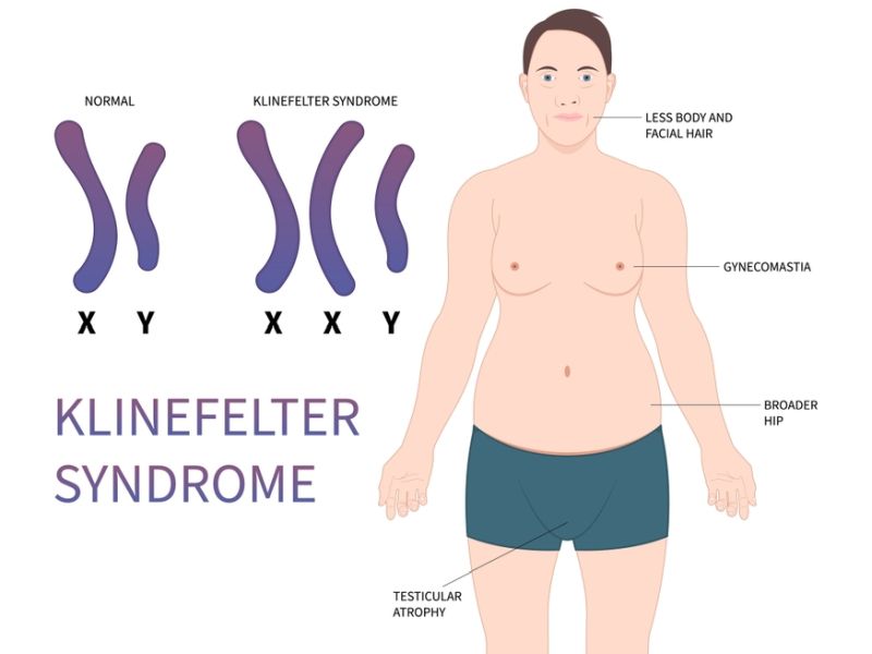 Klinefelter Syndrome Symptoms