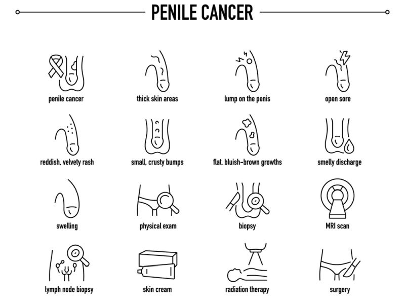Penile Cancer