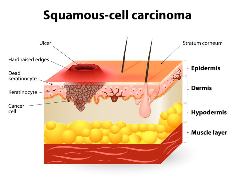 Squamous Cell Carcinoma Treatment