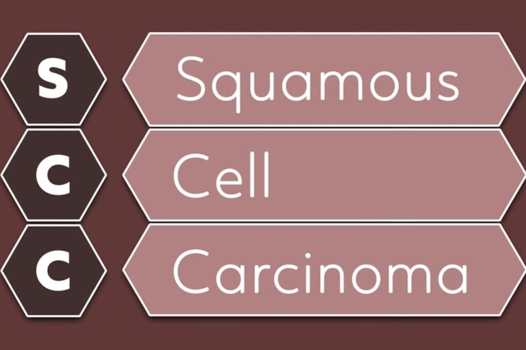 Moderately Differentiated Squamous Cell Carcinoma