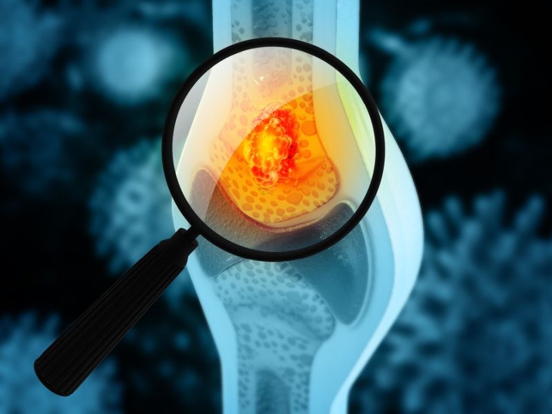 Osteosarcoma Symptoms