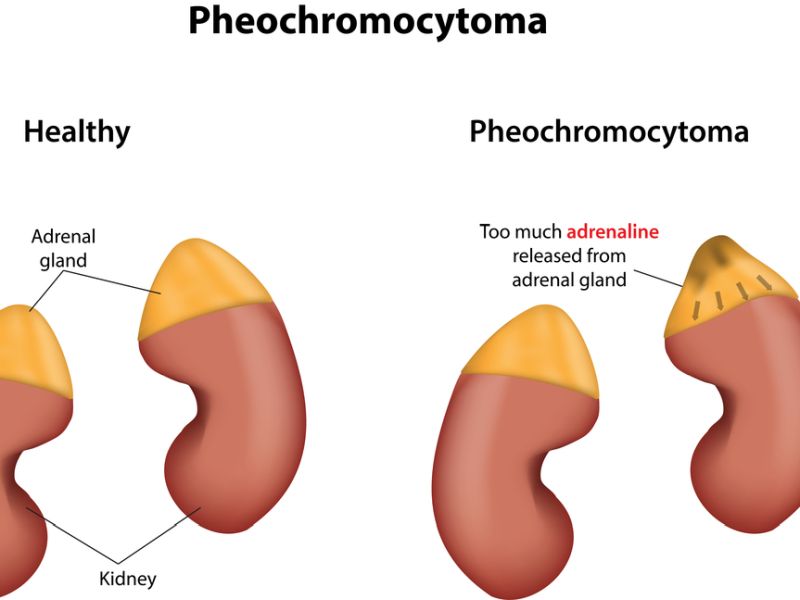 Pheochromocytoma Symptoms