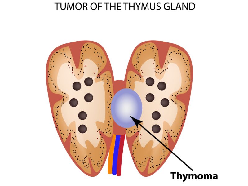 Thymoma Symptoms