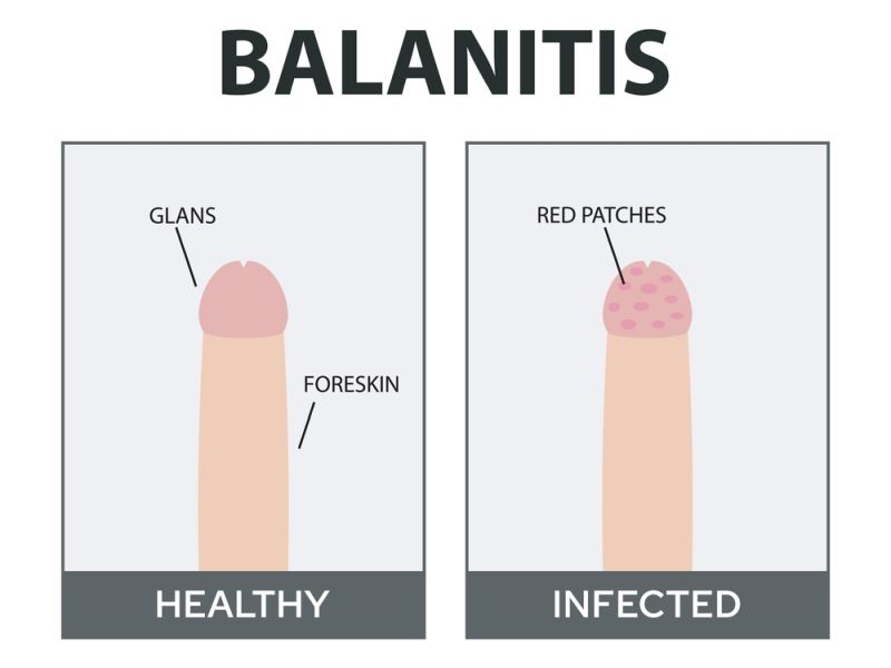 Balanitis Treatment