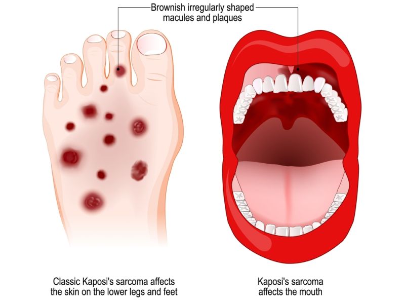 Kaposi Sarcoma
