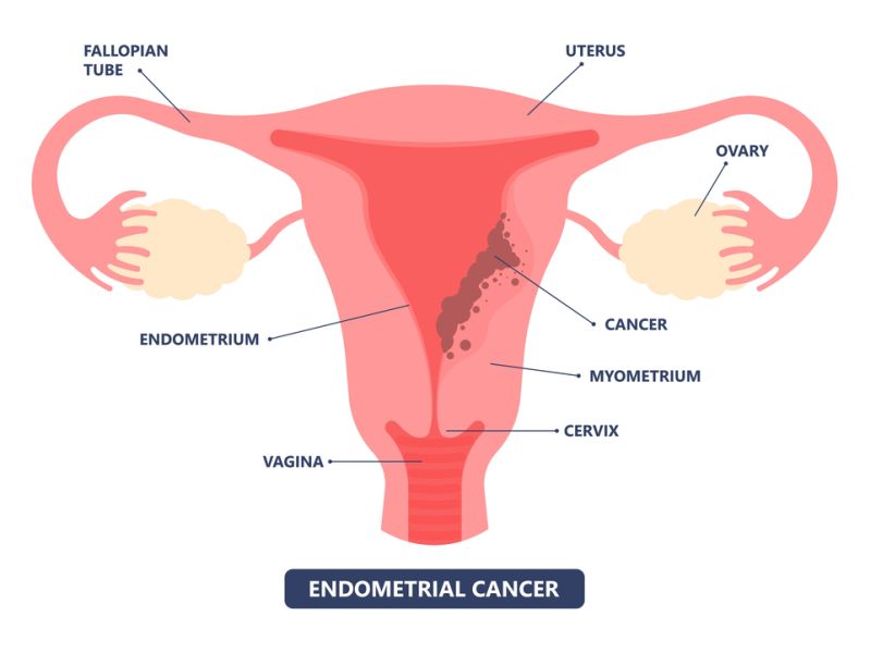 Endometrial Cancer