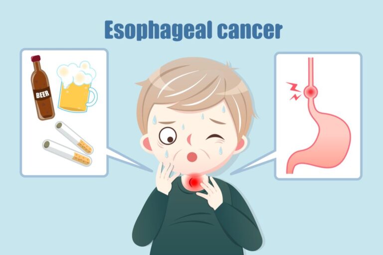 Esophageal Cancer Treatment