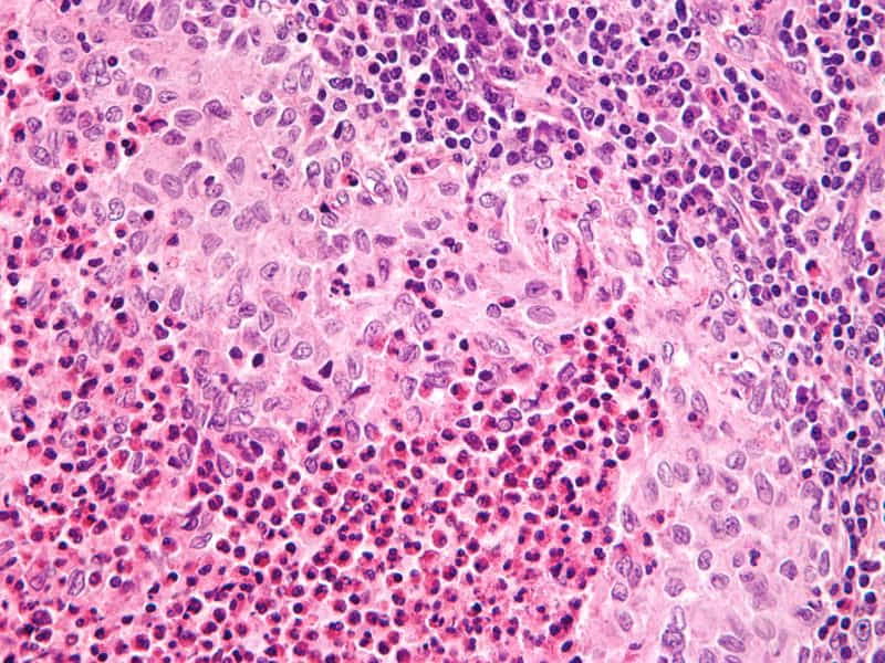 Langerhans Cell Histiocytosis Treatment