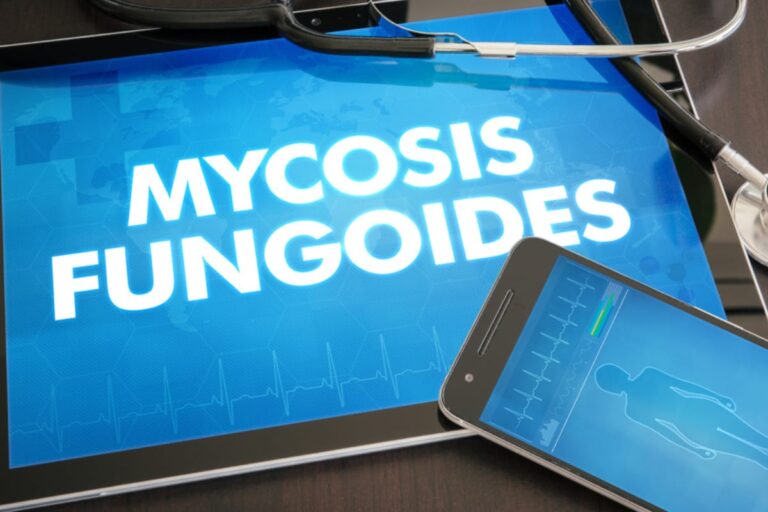 Mycosis Fungoides