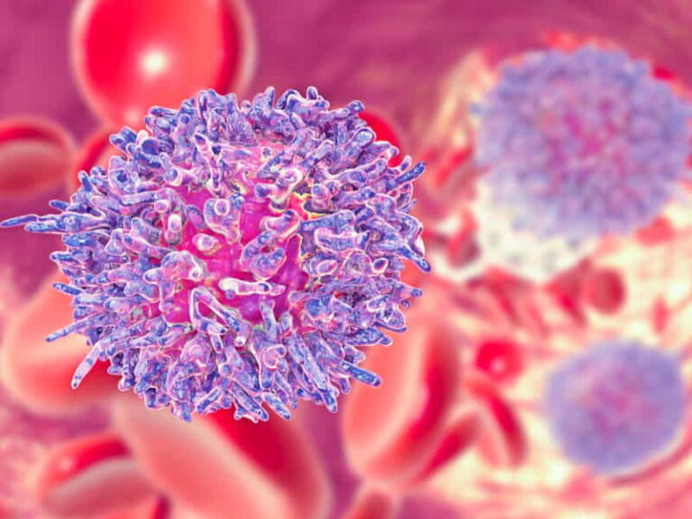 Myelofibrosis symptoms causes prognosis and treatment