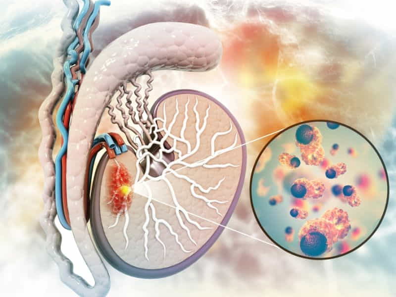 Testicular Cancer Symptoms