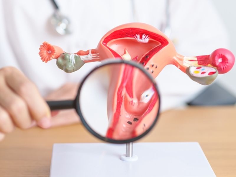 Uterine Sarcoma Diagnosis