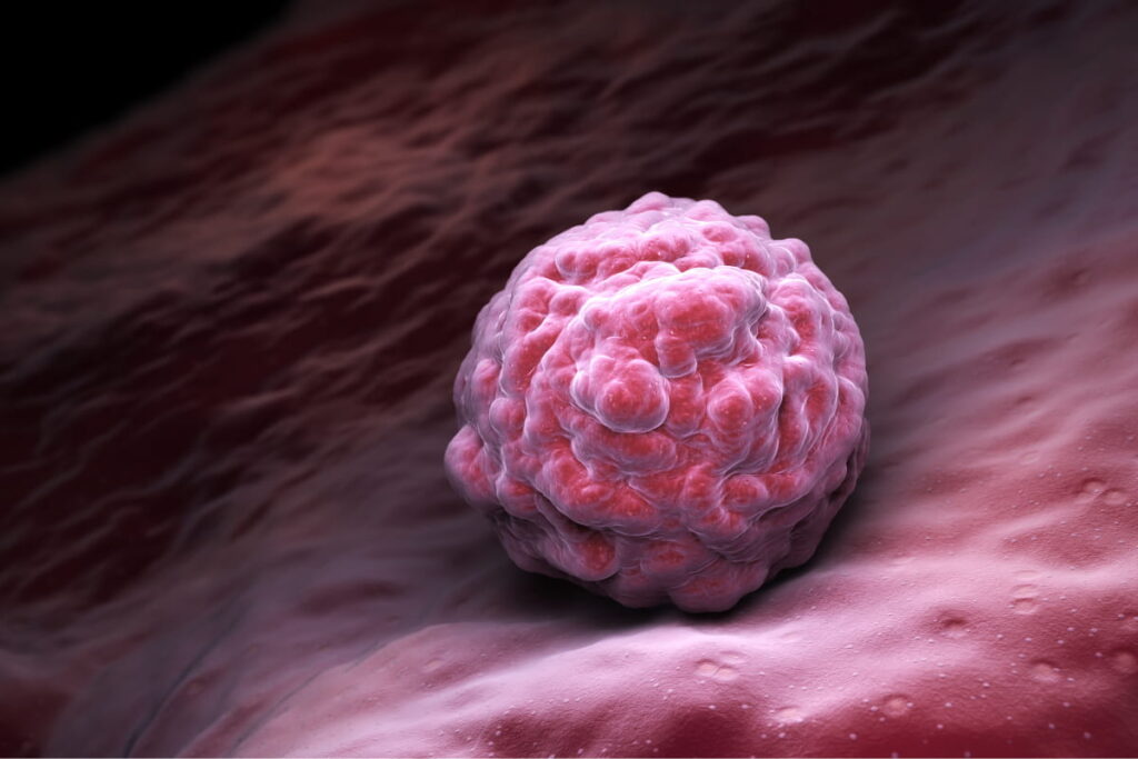 Ocular Melanoma Treatment