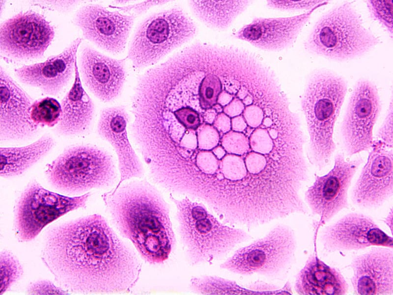Pharyngeal Cancer Diagnosis