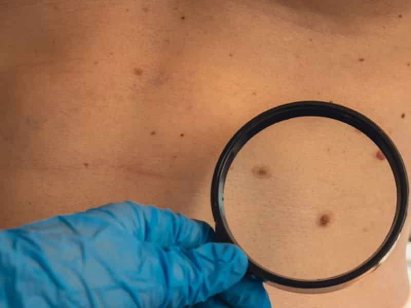 Melanoma Meaning