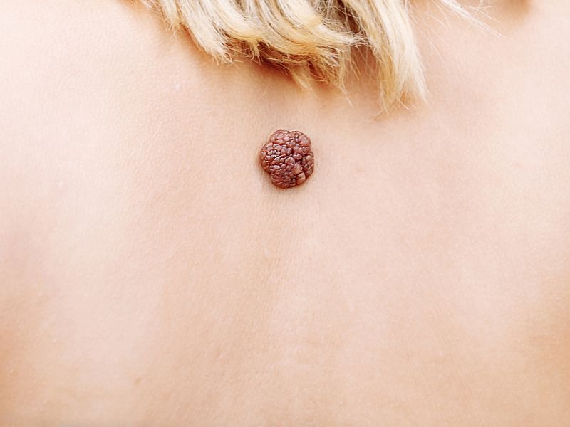 Signs Of Cancerous Moles