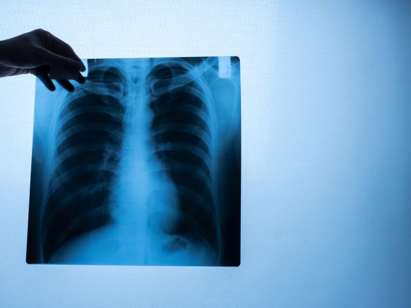 Tuberculosis Symptoms