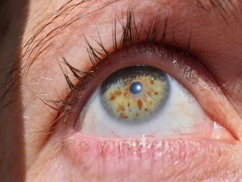 Xerophthalmia Classification