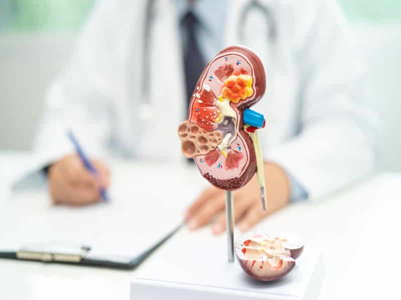Kidney Stones Treatment