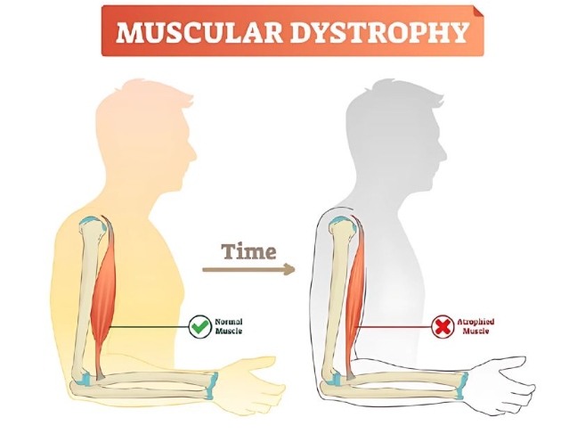 Becker Muscular Dystrophy, Impact Guru